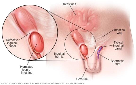 Illustration showing inguinal hernia