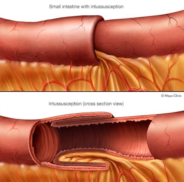 Illustration showing intussusception