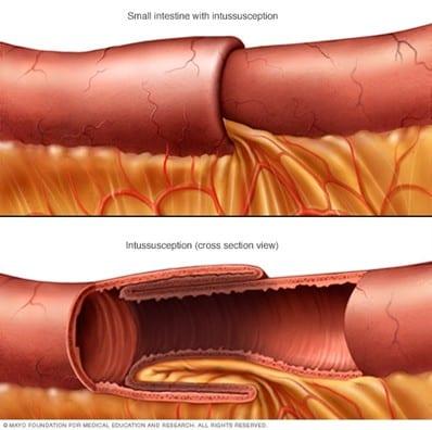 Illustration showing intussusception