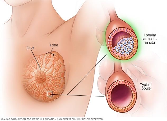 Lobular carcinoma in situ 