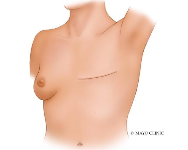 A person who has undergone a total (simple) mastectomy without breast reconstruction