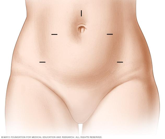 Incision locations for robotic hysterectomy