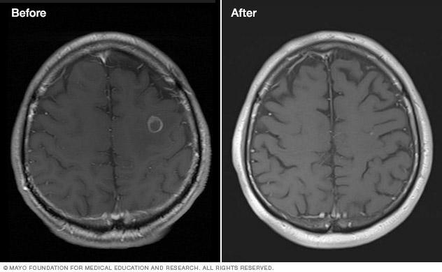 Scans of a brain tumor before and after treatment.