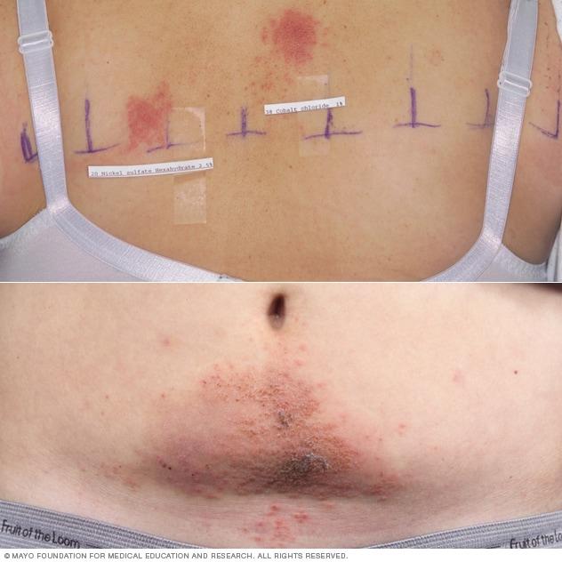 Photos showing nickel allergy rash