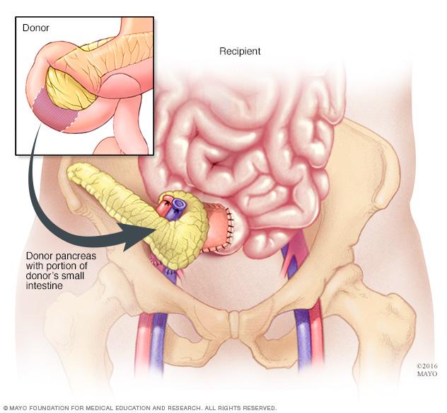 Transplanted pancreas