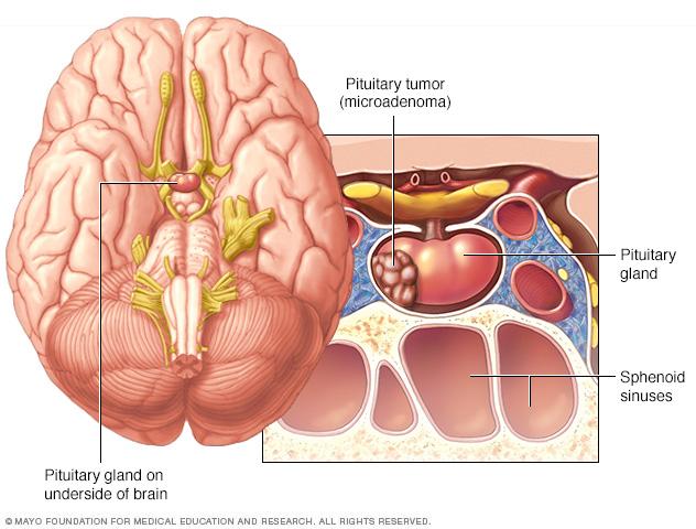 Pituitary tumor