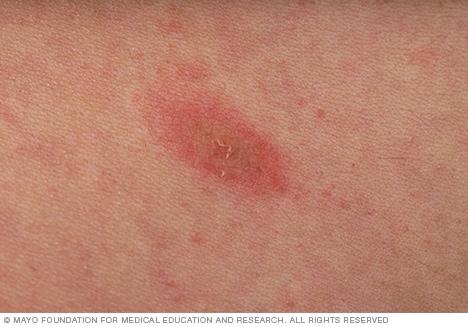 Herald patch of pityriasis rosea 