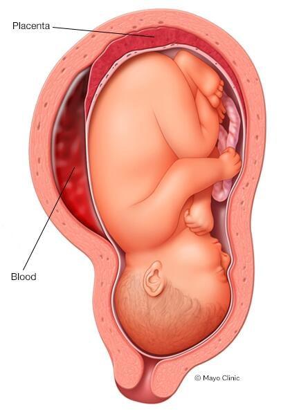 Placental abruption 
