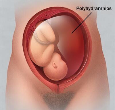 Excess amniotic fluid surrounding baby in the uterus (polyhydramnios)