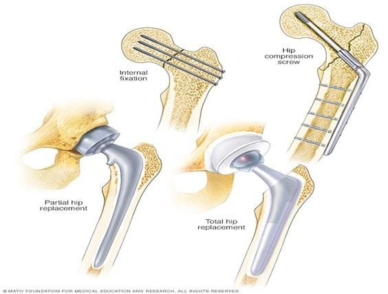 Hip fracture repair techniques