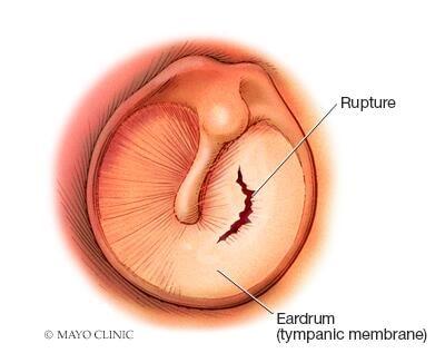 Illustration of eardrum, showing rupture