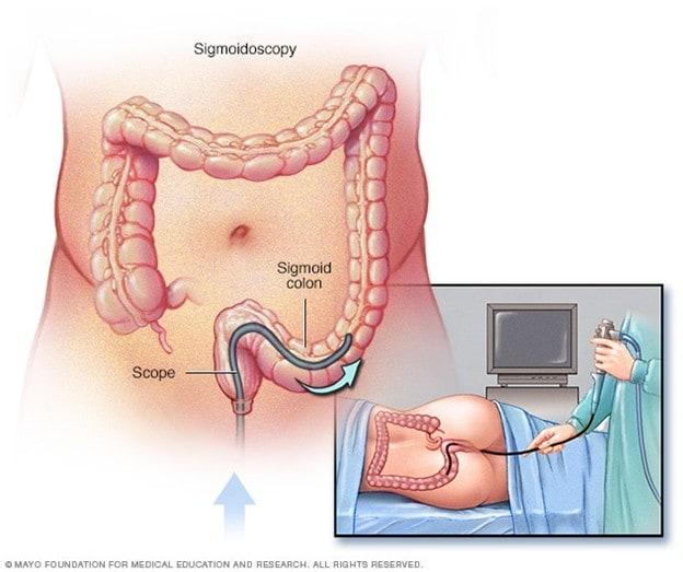 Illustration of flexible sigmoidoscopy exam