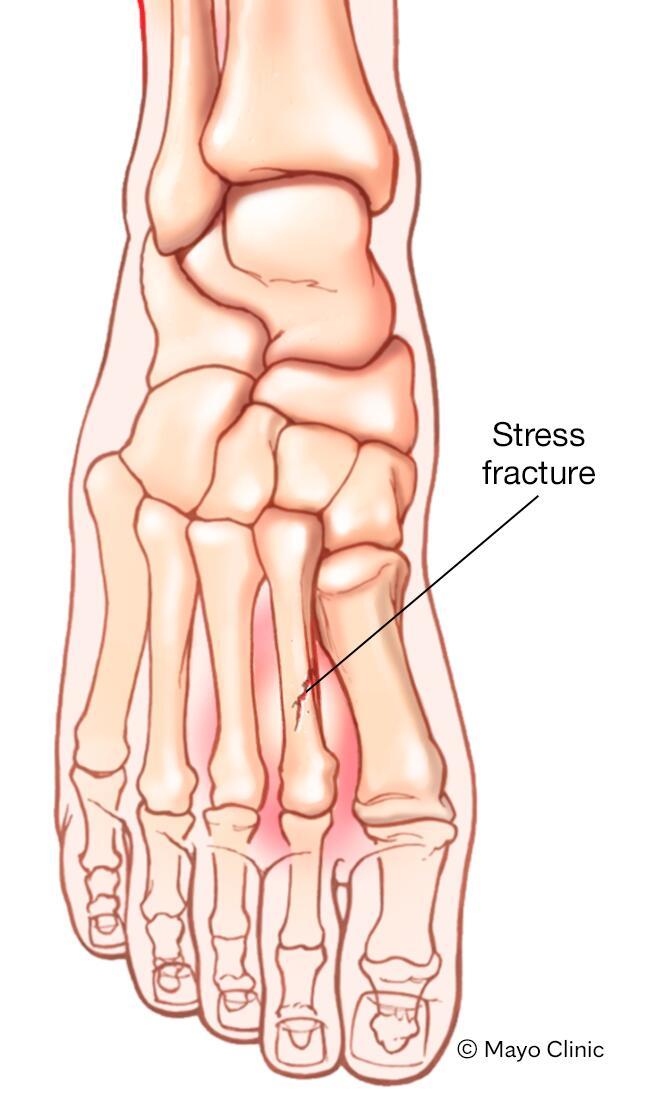 Stress fracture 