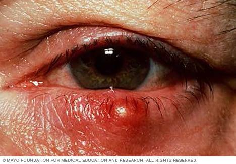Photograph showing a stye
