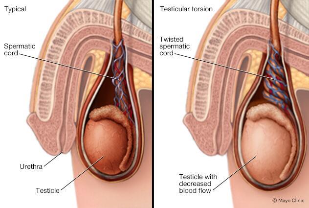 Illustration of penis before and during testicular torsion