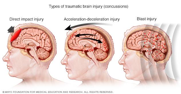 Damage in different areas of the brain based on injury type
