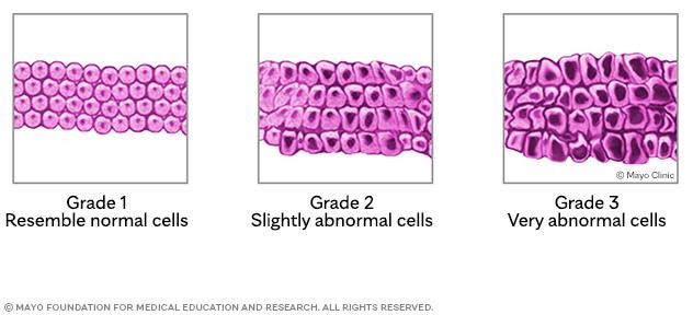 Tumor cells according to grade