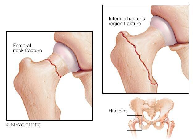 The two most common types of hip fractures